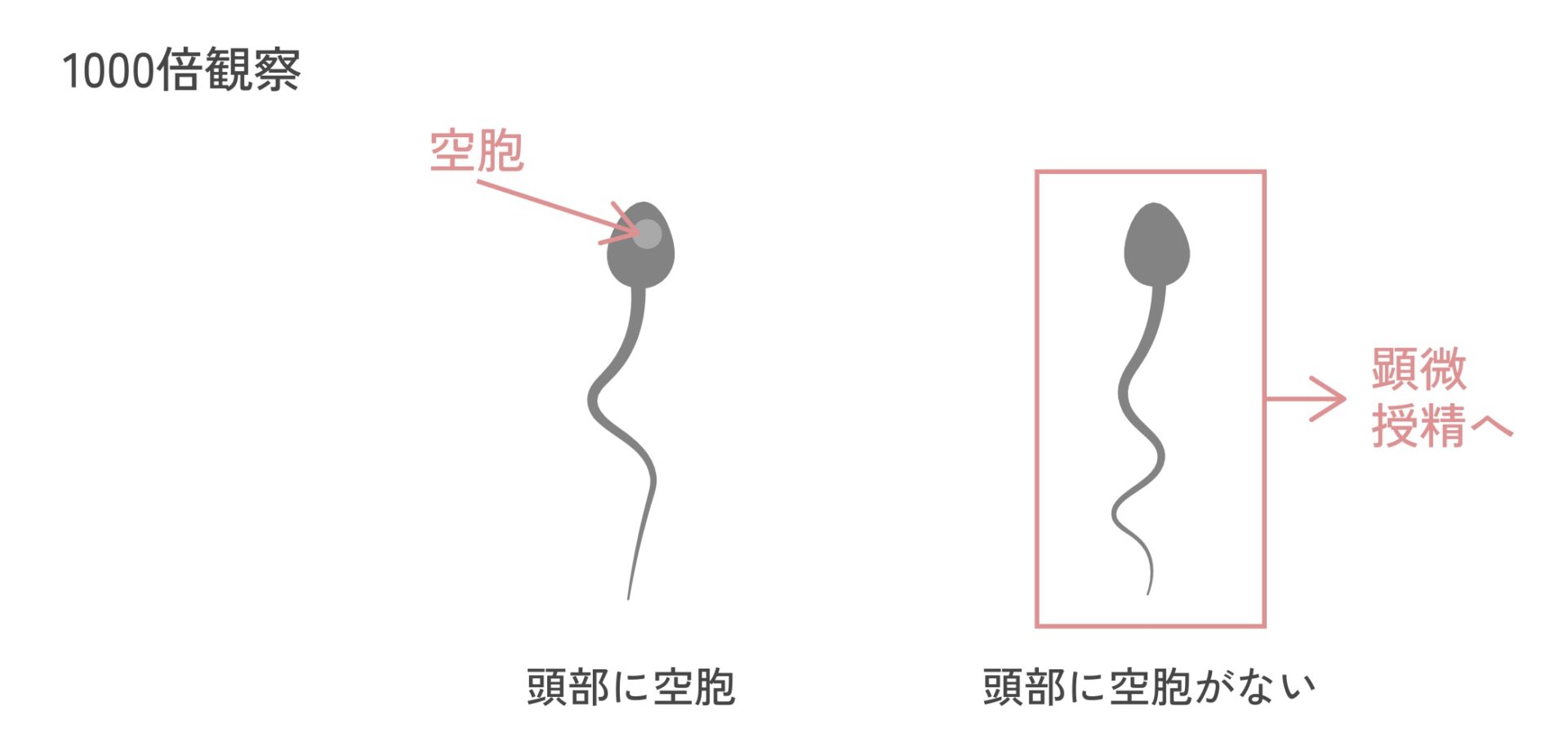 IMSI（先進医療）