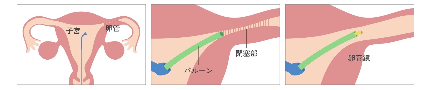 FT（卵管鏡下卵管形成術）の方法