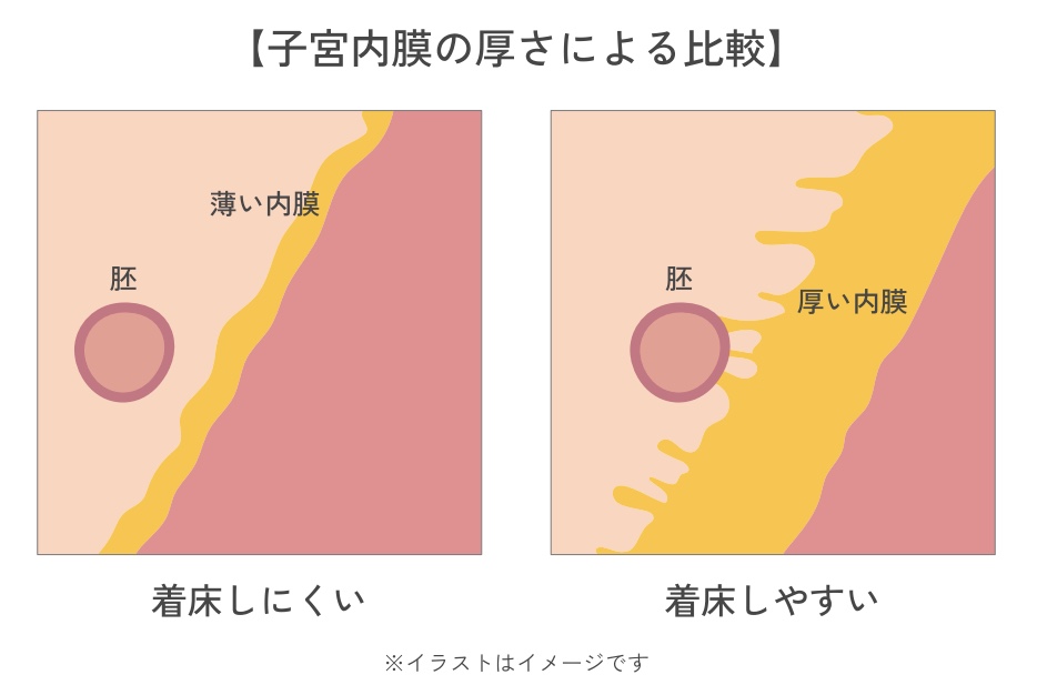 子宮内膜への注入メリット