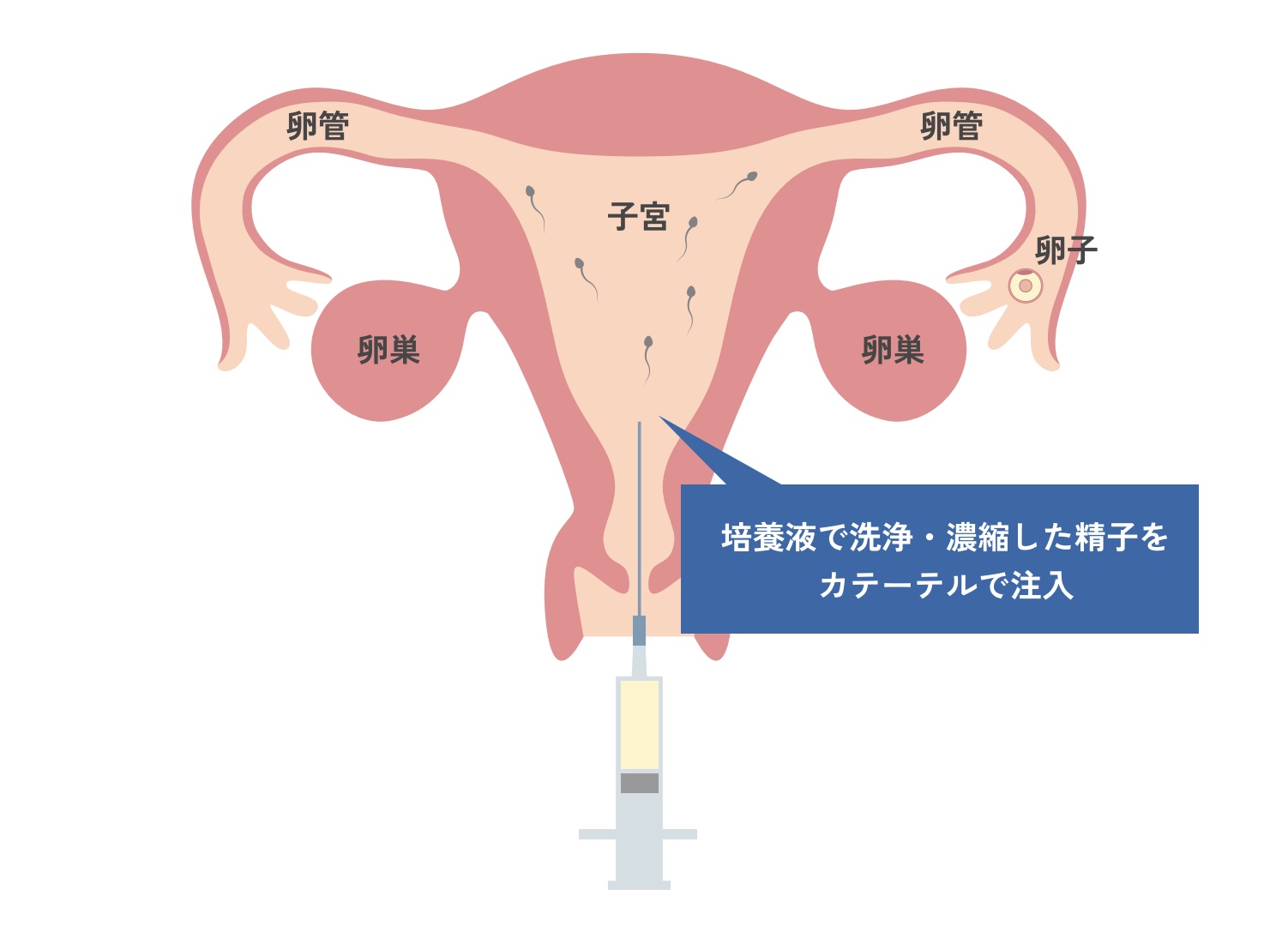 AIH（人工授精）とは？