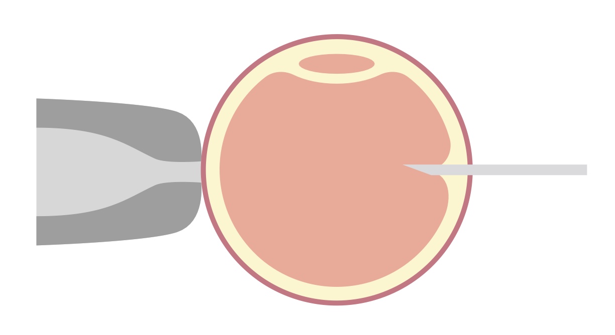 顕微授精（ICSI）